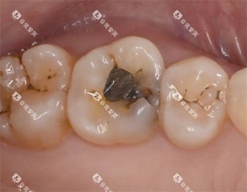 牙齿龋坏照片 牙齿龋坏照片