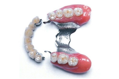 精密附着体和活动义齿成品