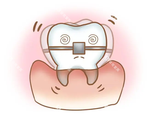 牙齿矫正松动.webp