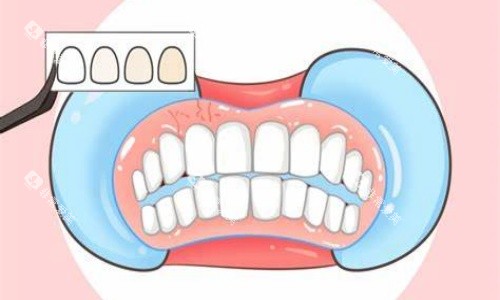 贴面美白示意图 贴面美白示意图
