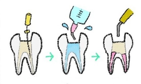 根管治疗过程漫画图 根管治疗过程漫画图