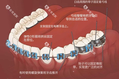 金属牙齿矫正器功能示意图 金属牙齿矫正器功能示意图
