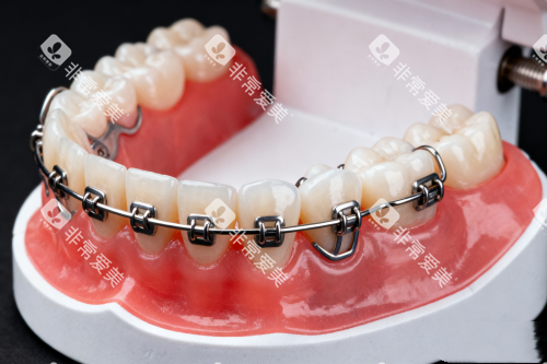 传统牙齿矫正器模型展示图