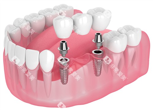 种植牙的构成 种植牙的构成