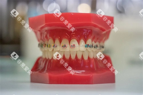 牙齿矫正宣传展示