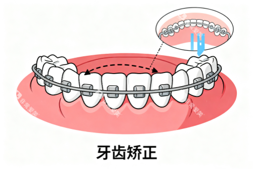 牙齿矫正卡通图片一览