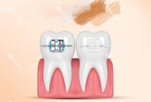 牙齿矫正金属和陶瓷托槽漫画图