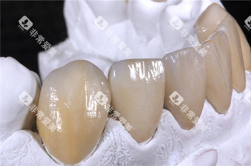 vita全瓷牙成品