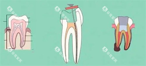 牙齿受损 牙齿受损