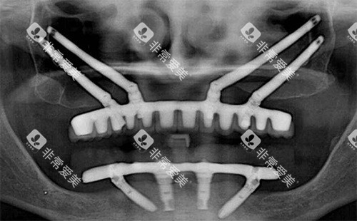 穿颧穿翼种植拍片 穿颧穿翼种植拍片