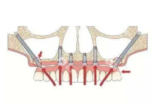穿颧穿翼种植卡通图片展示 穿颧穿翼种植卡通图片展示