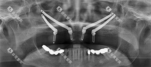 口腔穿颧穿翼 口腔穿颧穿翼
