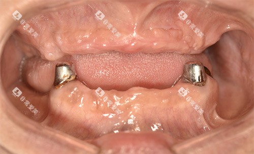 穿颧穿翼种植全口 穿颧穿翼种植全口