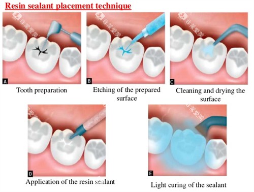 窝沟封闭流程图 窝沟封闭流程图