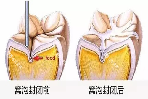 牙齿窝沟封闭前后对比卡通示意图 牙齿窝沟封闭前后对比卡通示意图