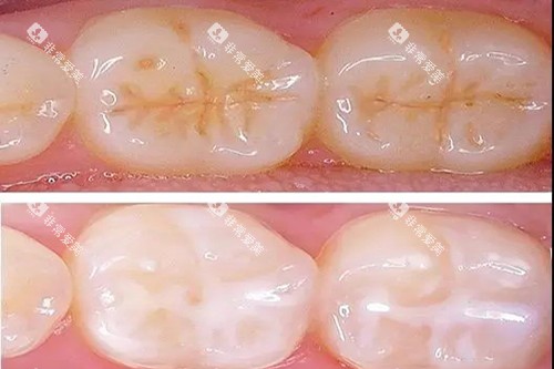 牙齿窝沟封闭对比示意图 牙齿窝沟封闭对比示意图