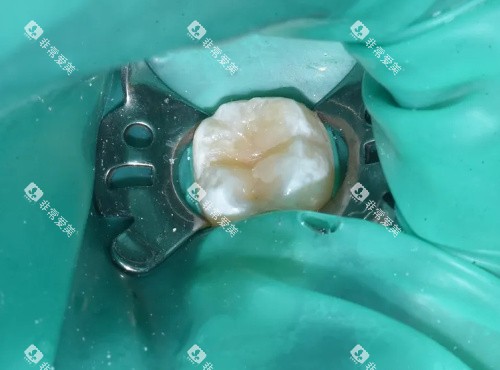 补牙治疗图 补牙治疗图