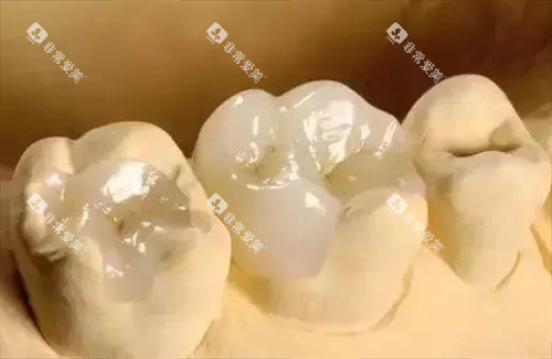 补牙模型展示图 补牙模型展示图