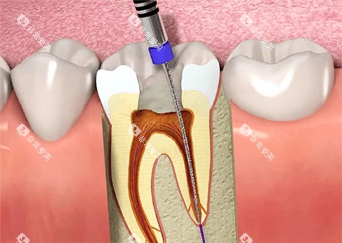牙齿根管治填充 牙齿根管治填充