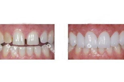 牙齿贴面修复卡通图 牙齿贴面修复卡通图