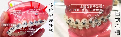 牙齿矫正牙套对比实物展示图