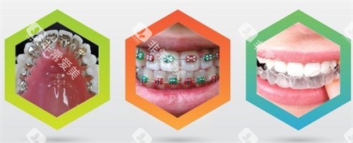 三种不同牙齿矫正牙套示意图 三种不同牙齿矫正牙套示意图