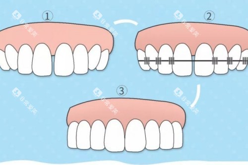 牙齿矫正步骤图 牙齿矫正步骤图