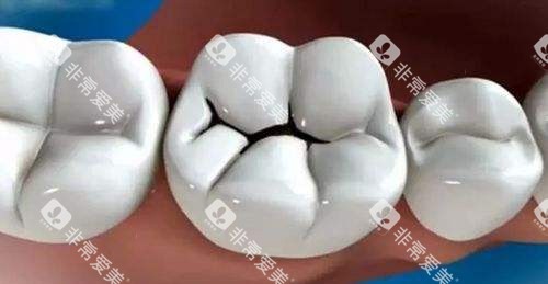 牙齿黑线龋齿漫画图