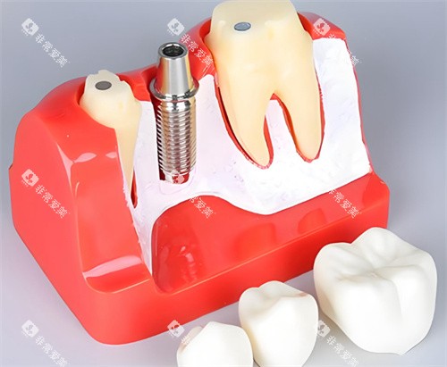 牙齿模型种植体 牙齿模型种植体