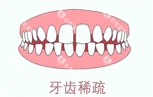 牙齿稀疏卡通示意图 牙齿稀疏卡通示意图