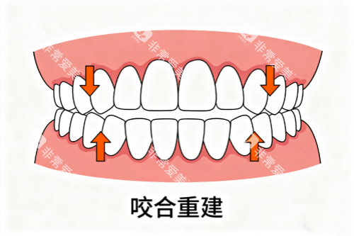牙齿咬合重建卡通展示图 牙齿咬合重建卡通展示图