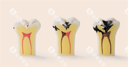 牙齿龋坏发展动画图 牙齿龋坏发展动画图