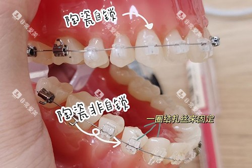 牙齿矫正陶瓷自锁托槽和非自锁牙套