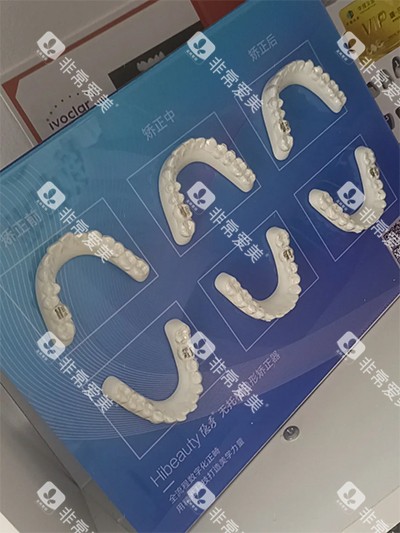 隐秀隐形牙齿矫正 隐秀隐形牙齿矫正