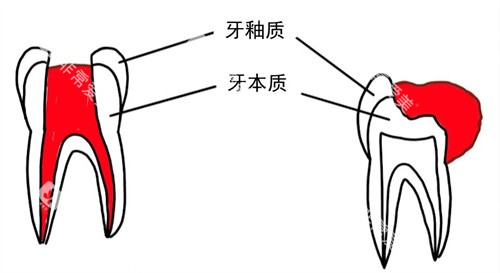 牙齿内息肉外溢