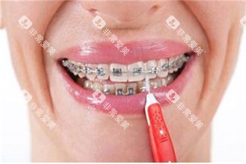 正在做正畸的牙齿宣传图