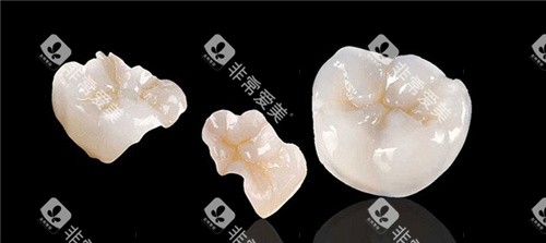 牙齿嵌体 牙齿嵌体