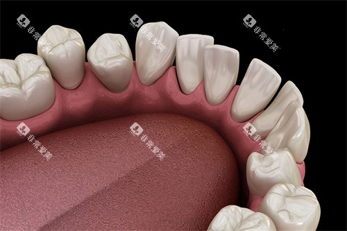牙齿不整齐内侧视角 牙齿不整齐内侧视角