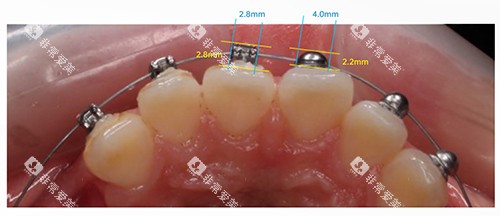 牙齿矫正OBrace球面托槽对比方形托槽大小 牙齿矫正OBrace球面托槽对比方形托槽大小