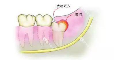 智齿冠周炎发炎漫画图