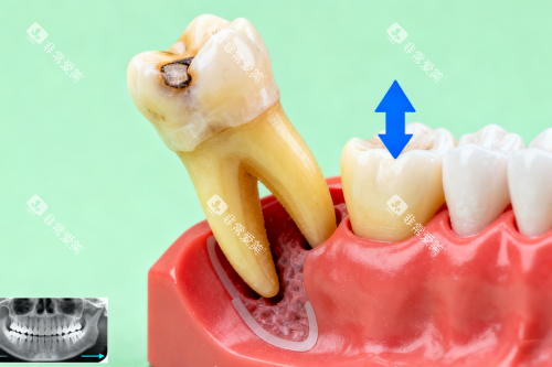 智齿拔除卡通展示图