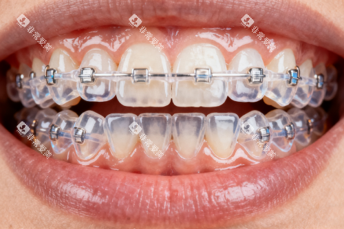 半隐形陶瓷矫正器图片