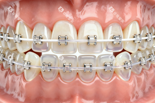 陶瓷半隐形矫正器卡通图片一览