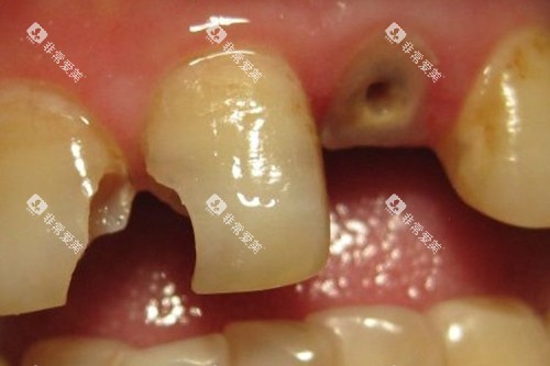 牙齿龋坏到牙根 牙齿龋坏到牙根