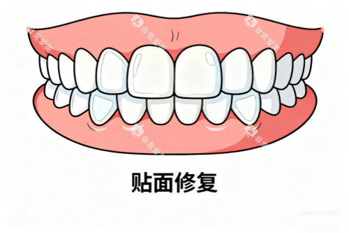 牙齿贴面修复卡通图