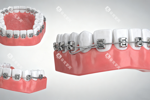 牙齿矫正模型图片 牙齿矫正模型图片