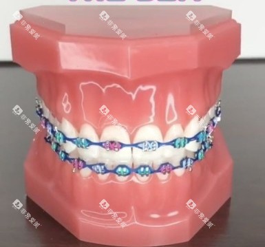 牙齿矫正牙套模型示意图