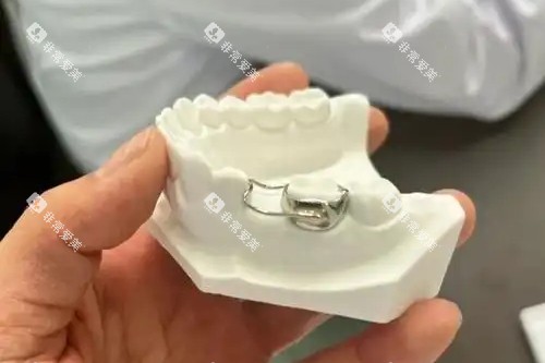 儿童牙齿间隙保持器