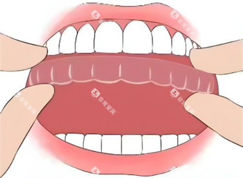 隐形矫正图片展示