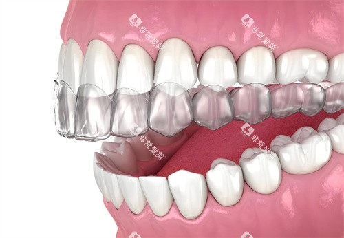 牙齿隐形矫正 牙齿隐形矫正